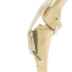 Diagram of the MMP implant advancing the tibial tuberosity in a dog knee
